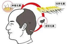 ​东莞台心医院植发科怎么样正规吗？发友评价很棒很靠谱