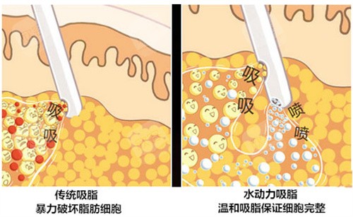 吸脂手术方式图 吸脂手术方式图