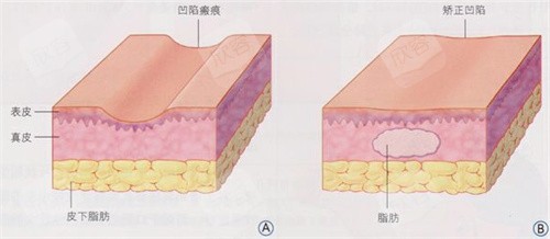 脂肪填充图片 脂肪填充图片