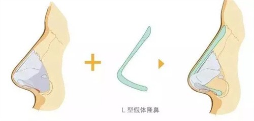 L型假体动画展示图 L型假体动画展示图