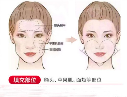 脂肪填充动画对比照 脂肪填充动画对比照