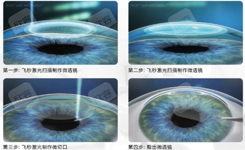 全飞秒手术过程图 全飞秒手术过程图