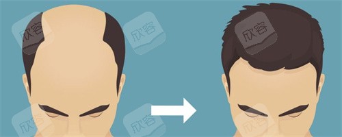头顶加密种植对比图 头顶加密种植对比图