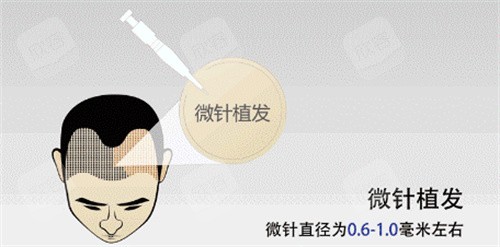 微针植发动画图 微针植发动画图