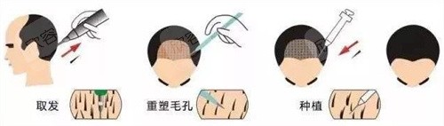 植发过程展示图 植发过程展示图