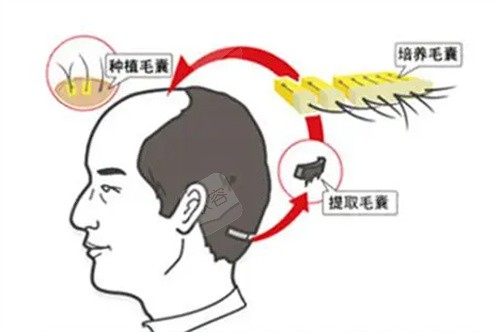 植发毛囊提取过程展示 植发毛囊提取过程展示