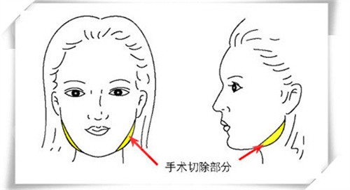 下颌角截骨动画图 下颌角截骨动画图