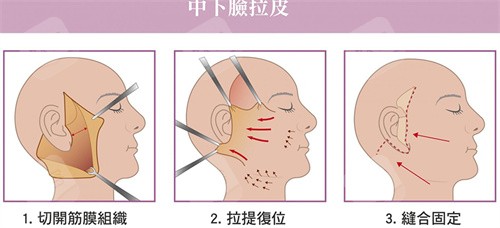 中下面部拉皮手术流程图 中下面部拉皮手术流程图