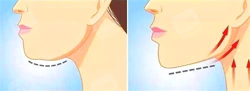 拉皮手术动画图 拉皮手术动画图