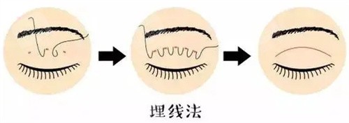 埋线双眼皮图 埋线双眼皮图