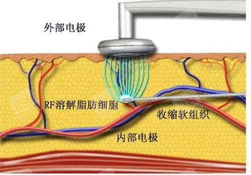 传统吸脂器 传统吸脂器