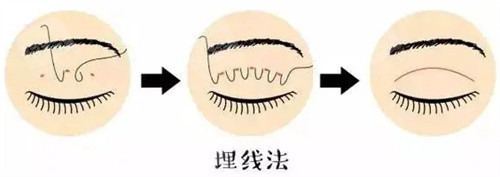 埋线双眼皮图 埋线双眼皮图