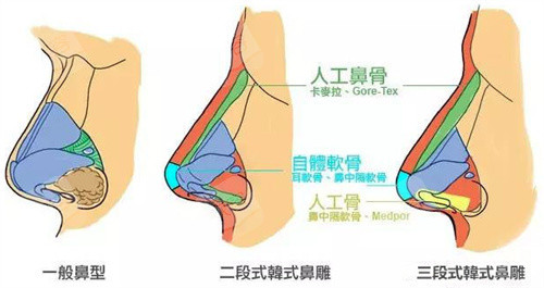 鼻型图 鼻型图