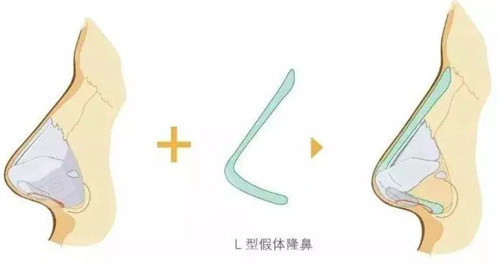 假体隆鼻 假体隆鼻