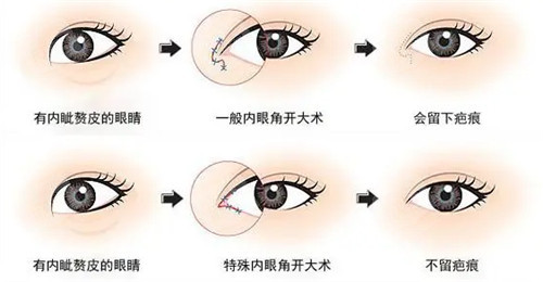 眼角手术细节图