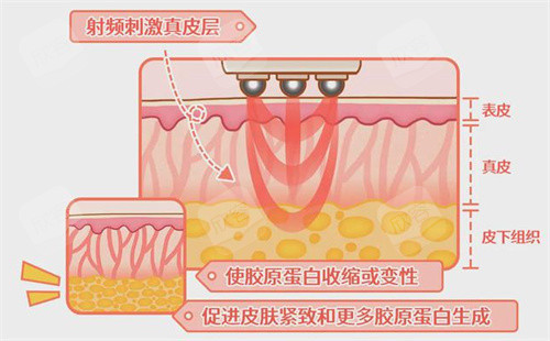 热玛吉示意 热玛吉示意