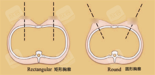 不同胸廓形状展示图