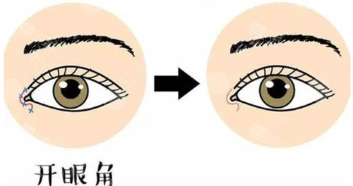 开眼角图片 开眼角图片