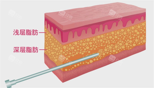浅层吸脂与深层吸脂动画图 浅层吸脂与深层吸脂动画图