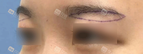 提眉手术设计图 提眉手术设计图