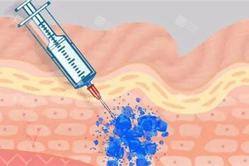 注射原理细节图 注射原理细节图