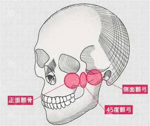 正面侧面颧骨图