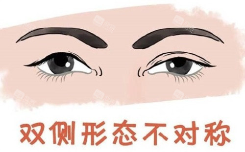 双眼皮形态不对称示意图 双眼皮形态不对称示意图