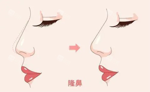 隆鼻示意图 隆鼻示意图