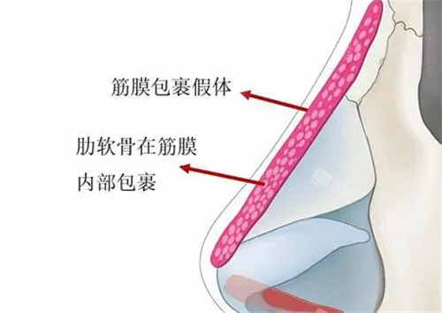肋软骨支架包裹结构 肋软骨支架包裹结构