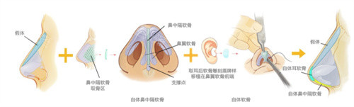 自体软骨隆鼻过程展示 自体软骨隆鼻过程展示