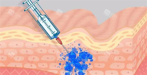 玻尿酸注射动画图 玻尿酸注射动画图