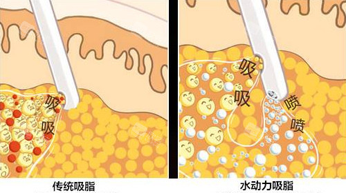 不同吸脂方式对比图 不同吸脂方式对比图