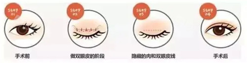 双眼皮手术动画方式 双眼皮手术动画方式