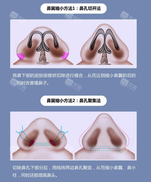鼻翼缩小方法图 鼻翼缩小方法图