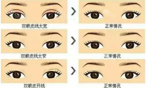 双眼皮修复三种情况 双眼皮修复三种情况