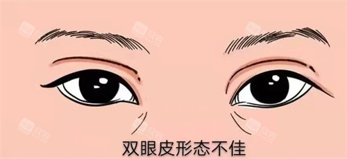 双眼皮形态不佳图 双眼皮形态不佳图