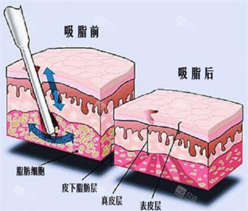吸脂手术前后图 吸脂手术前后图