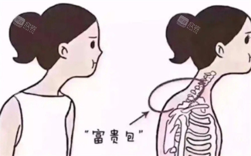 正常背部和富贵包背部对比 正常背部和富贵包背部对比