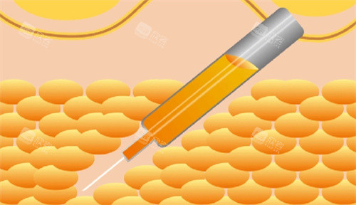 吸脂动画图 吸脂动画图