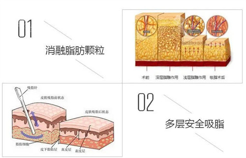 两种不同的吸脂方法 两种不同的吸脂方法