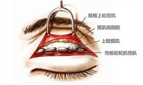 双眼皮剥离缝合图 双眼皮剥离缝合图