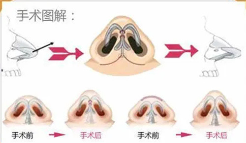 鼻翼手术步骤图解 鼻翼手术步骤图解