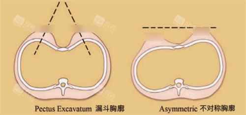 胸廓形态展示图 胸廓形态展示图