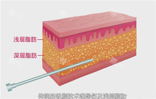吸脂手术动画图 吸脂手术动画图