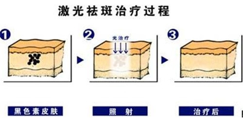 激光祛斑治疗过程 激光祛斑治疗过程