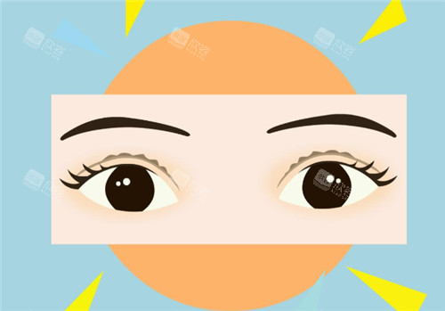 双眼皮手术卡通图 双眼皮手术卡通图