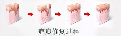 疤痕修复示意图 疤痕修复示意图