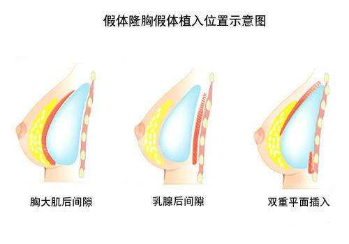 假体植入位置示意图