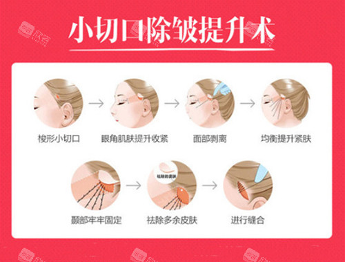小切口除皱术图示 小切口除皱术图示
