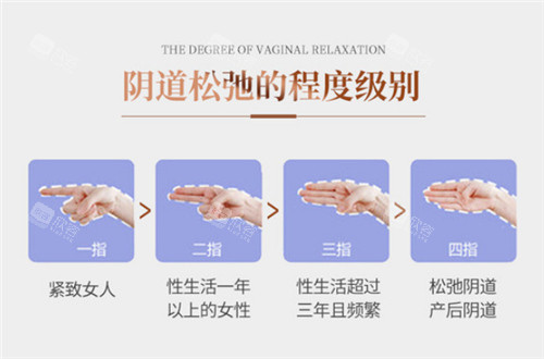 阴道松弛程度级别 阴道松弛程度级别